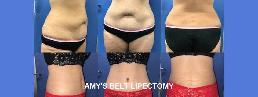 Amy's belt lipectomy