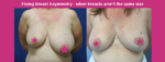 Fixing Breast Asymmetry