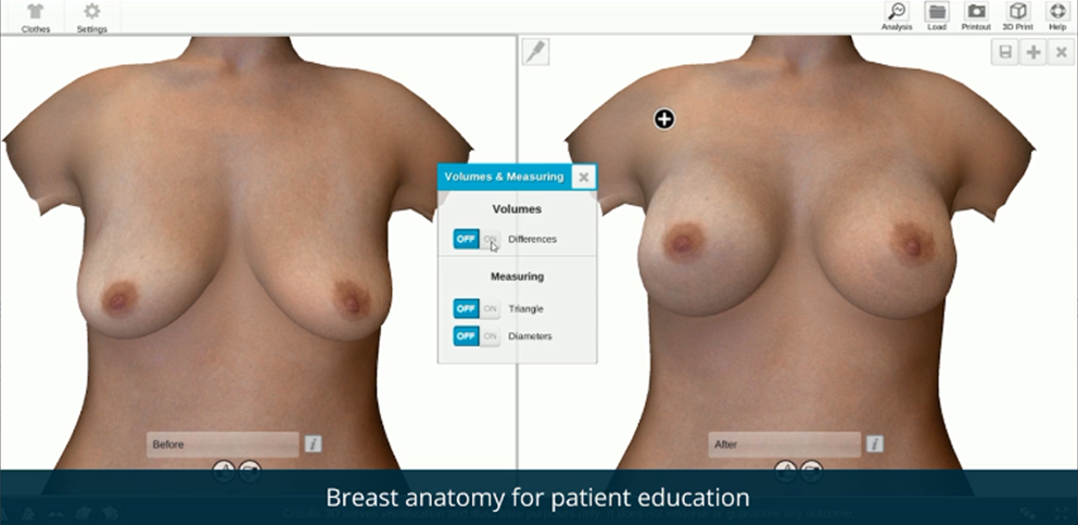 Breast augmentation after children