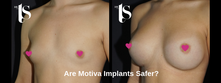 Motiva Implants Safer