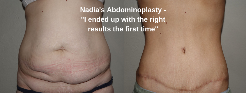 Nadia's abdominoplasty