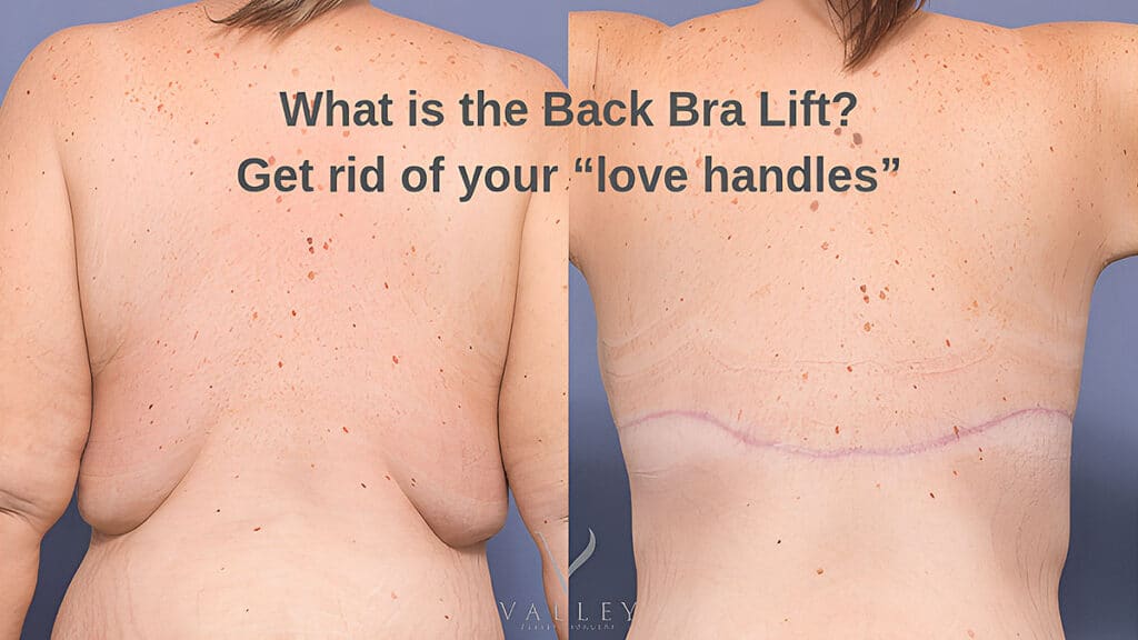 back bra lift Get rid of your “love handles” - plastic Surgery Hub