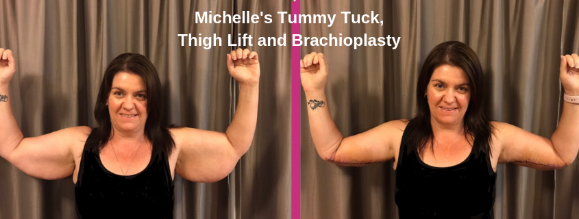 Michelle's Tummy Tuck