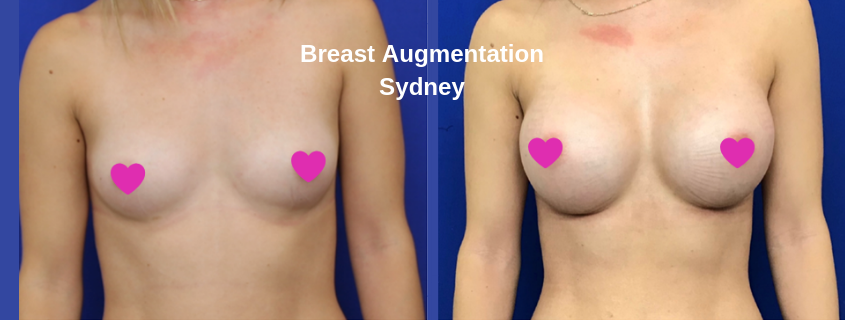 Breast Augmentation Sydney