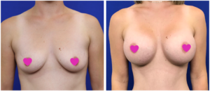 Breast Augmentation Sydney