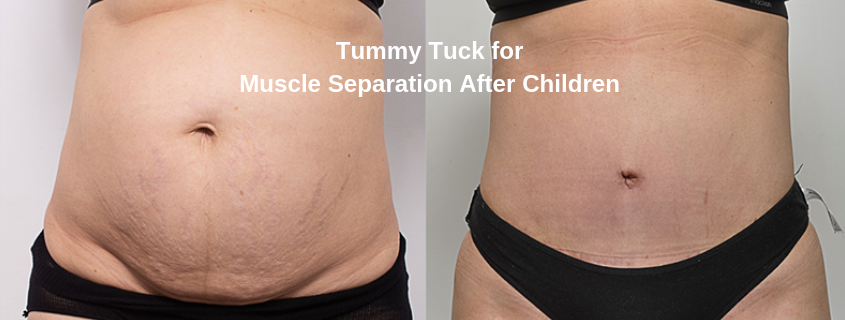 Muscle separation after children