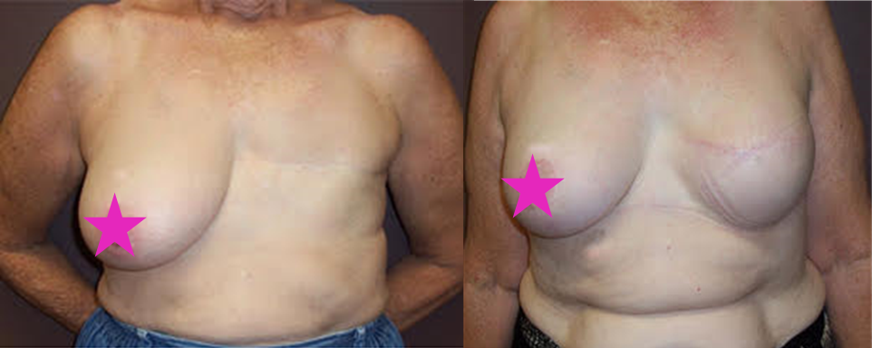 Breast Reconstruction Cairns