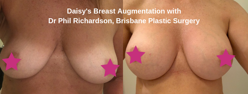 Daisy's Breast Augmentation