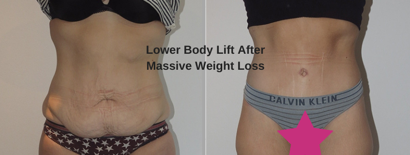 Lower Body Lift After Massive Weight Loss