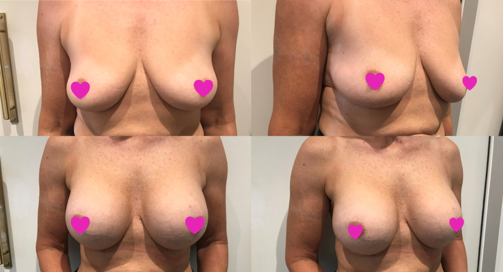 Daisy's Breast Augmentation