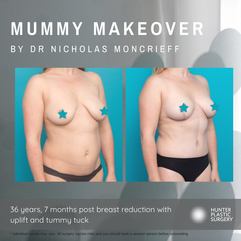 Lisa's Mummy Makeover