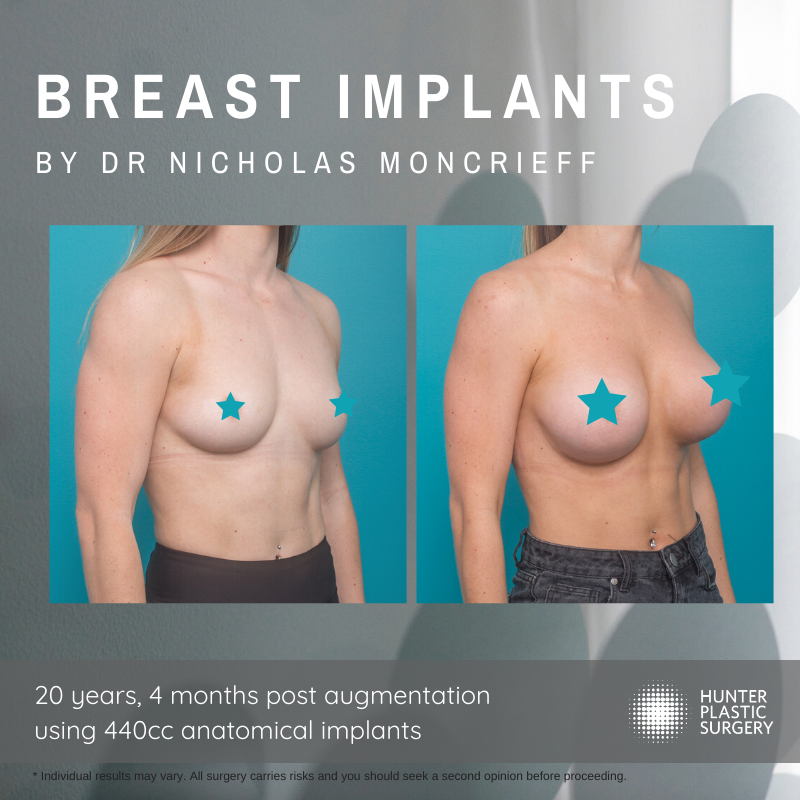 Brittany's Breast Augmentation
