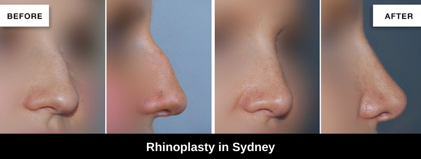 Rhinoplasty Sydney