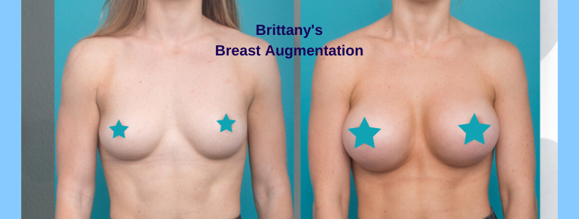 Brittany's Breast Augmentation