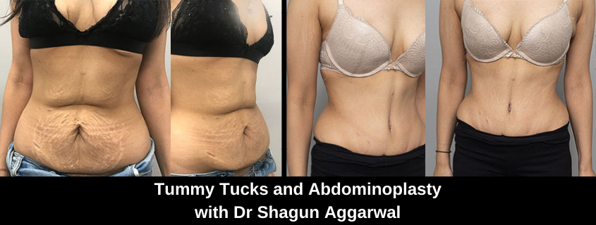 Abdominoplasty Dr Shagun Aggarwal