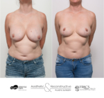 Previous surgery performed elsewhere. This patient is now 11 months post explant of breast implants and breast lift.