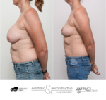 Previous surgery performed elsewhere. This patient is now 11 months post explant of breast implants and breast lift.