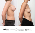 This lady in her 50s had several surgeries elsewhere over the years and developed recurrent capsular contracture and breast discomfort. She is now 6 months post total capsulectomy and removal of textured breast implants.