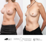 This lady in her 50s had several surgeries elsewhere over the years and developed recurrent capsular contracture and breast discomfort. She is now 6 months post total capsulectomy and removal of textured breast implants.