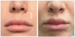 The Lip Lift Procedure with Dr Raymond Goh