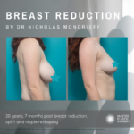 Breast Reduction by Nicholas Mancrieff