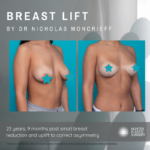 Breast Reduction by Nicholas Mancrieff
