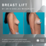 Breast Lift by Nicholas Mancrieff