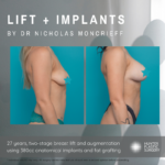 Breast Lift + Implants by Nicholas Mancrieff
