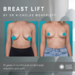 Breast Lift + Implants by Nicholas Mancrieff