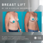 Breast Lift by Nicholas Mancrieff