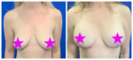 Options for Breast Lift with Implants with Dr Ziggy Moradi