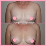 Dr Craig Rubinstein Breast Augmentation