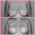 Dr Craig Rubinstein Breast Augmentation