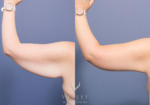 Dr Peters - Brachioplasty before & after