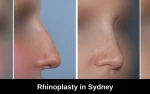 Rhinoplasty in Sydney Blog Featured Image - Blog Featured Image