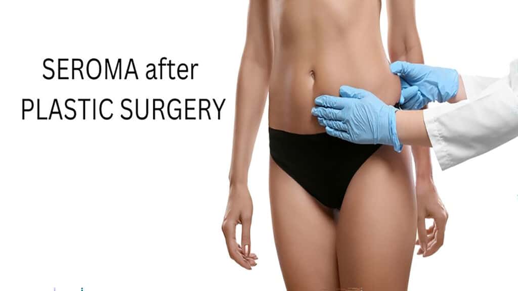 Seroma - Plastic Surgery Hub