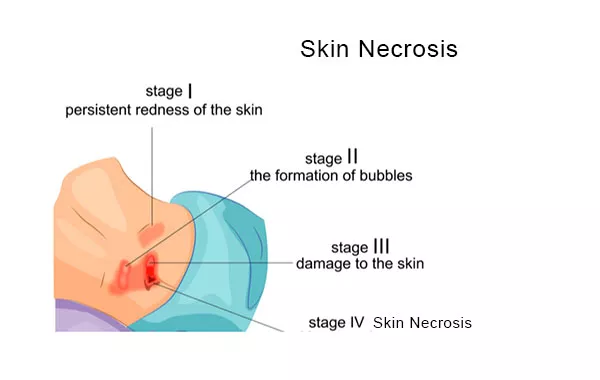 Skin Necrosis – Possible Post Surgery Complication for Plastic Surgery Featured Image - Skin Necrosis Image