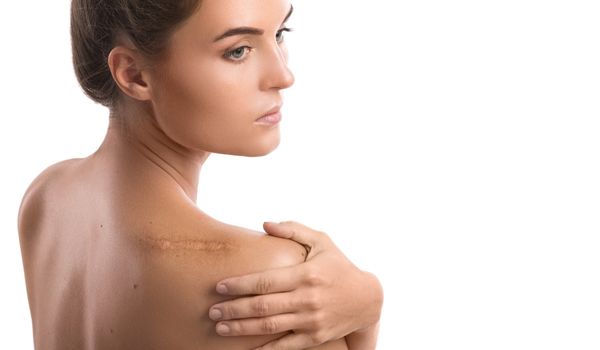 Causes of Hypertrophic Scars and Keloids after Plastic Surgery