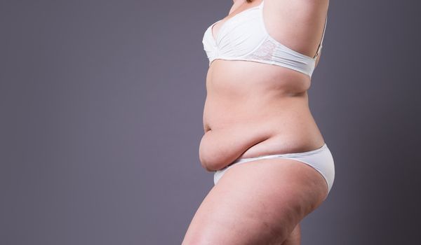 What Is A Tummy Tuck?