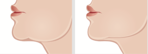 Face Lift Surgery for Jowls