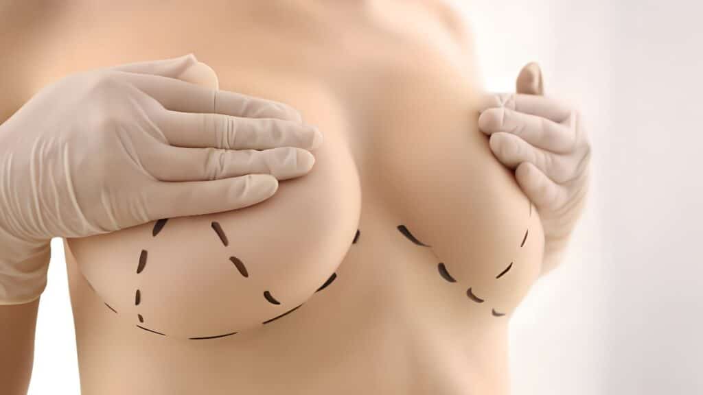 What Is a T Junction Breakdown - Plastic Surgery Hub